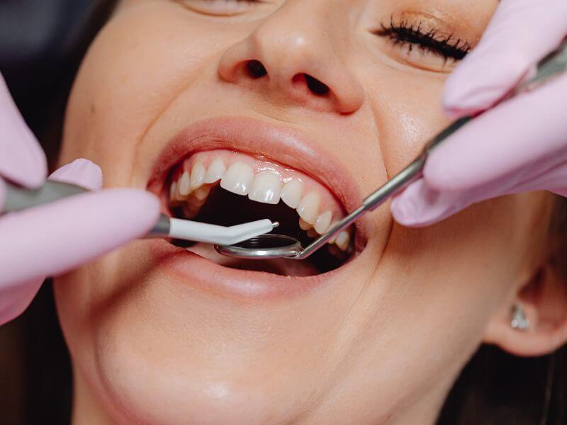 Rellenos Dentales
