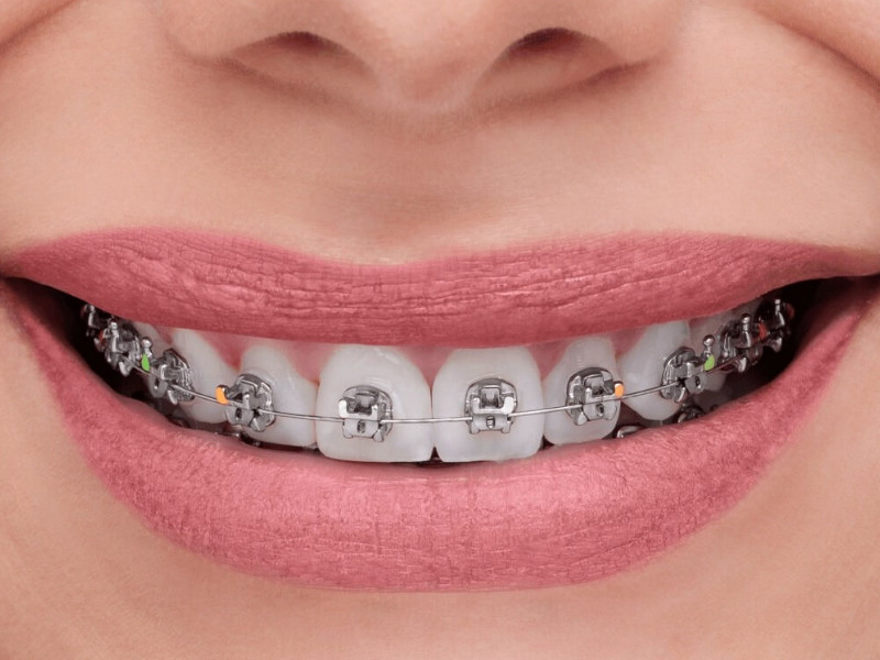 Brackets Autoligado